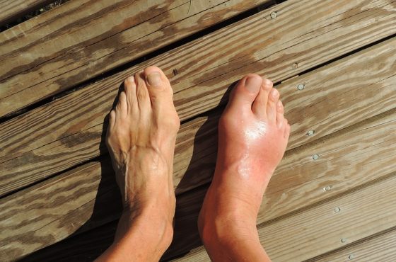 Barefoot Human Feet Pain Foot Anomaly Gout